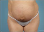 Before Image: Mesh Abdominoplasty - front