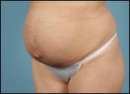 Before Image: Mesh Abdominoplasty - left-front-oblique