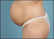 Before Image: Mesh Abdominoplasty - left-side