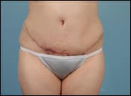 After Image: Mesh Abdominoplasty - front