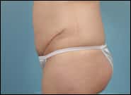 After Image: Mesh Abdominoplasty - left-side