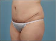 After Image: Mesh Abdominoplasty - left-front-oblique