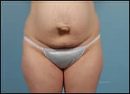 Before Image: Mesh Abdominoplasty - front