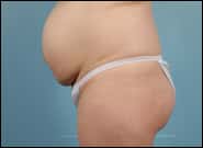 Before Image: Mesh Abdominoplasty - left-side