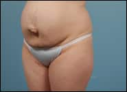 Before Image: Mesh Abdominoplasty - left-front-oblique