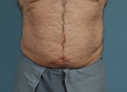After Image: Mesh Abdominoplasty - front