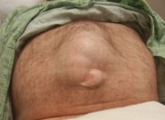 Before Image: Mesh Abdominoplasty - front