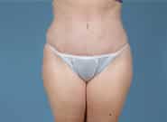 After Image: Mesh Abdominoplasty - front