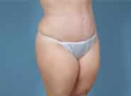 After Image: Mesh Abdominoplasty - right-front-oblique