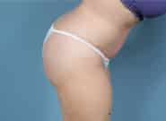 After Image: Mesh Abdominoplasty - right-side