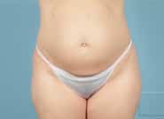 Before Image: Mesh Abdominoplasty - front