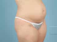 Before Image: Mesh Abdominoplasty - right-front-oblique
