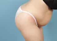 Before Image: Mesh Abdominoplasty - right-side