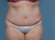 After Image: Mesh Abdominoplasty - front