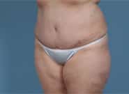 After Image: Mesh Abdominoplasty - left-front-oblique