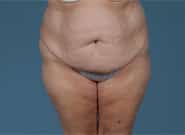 Before Image: Mesh Abdominoplasty - front