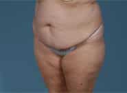 Before Image: Mesh Abdominoplasty - left-front-oblique