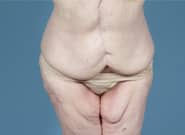 After Image: Mesh Abdominoplasty - front