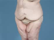 After Image: Mesh Abdominoplasty - left-front-oblique
