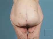 Before Image: Mesh Abdominoplasty - front