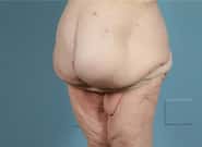 Before Image: Mesh Abdominoplasty - left-front-oblique