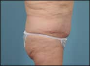 After Image: Mesh Abdominoplasty - right-side
