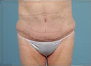 After Image: Mesh Abdominoplasty - front