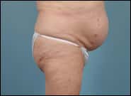 Before Image: Mesh Abdominoplasty - right-side