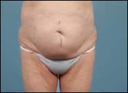 Before Image: Mesh Abdominoplasty - front