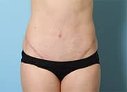 After Image: Mesh Abdominoplasty - front