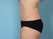 After Image: Mesh Abdominoplasty - left-side
