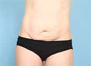 Before Image: Mesh Abdominoplasty - front
