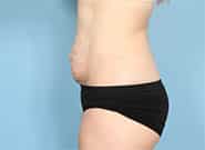 Before Image: Mesh Abdominoplasty - left-side