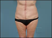 After Image: Mesh Abdominoplasty - front