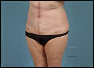 After Image: Mesh Abdominoplasty - left-front-oblique