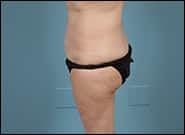 After Image: Mesh Abdominoplasty - left-side