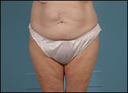 Before Image: Mesh Abdominoplasty - front