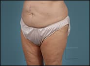Before Image: Mesh Abdominoplasty - left-front-oblique