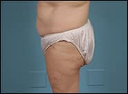 Before Image: Mesh Abdominoplasty - left-side