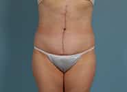 After Image: Mesh Abdominoplasty - front