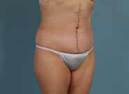 After Image: Mesh Abdominoplasty - right-front-oblique