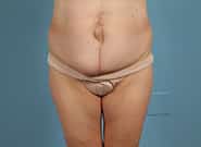 Before Image: Mesh Abdominoplasty - front