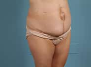 Before Image: Mesh Abdominoplasty - right-front-oblique