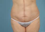 After Image: Mesh Abdominoplasty - front