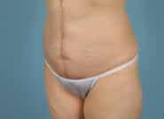 After Image: Mesh Abdominoplasty - left-front-oblique