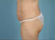 After Image: Mesh Abdominoplasty - left-side