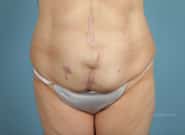 Before Image: Mesh Abdominoplasty - front