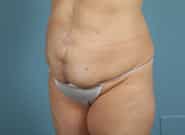 Before Image: Mesh Abdominoplasty - left-front-oblique