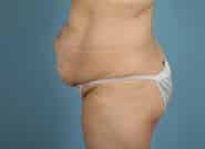Before Image: Mesh Abdominoplasty - left-side