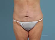 After Image: Mesh Abdominoplasty - front